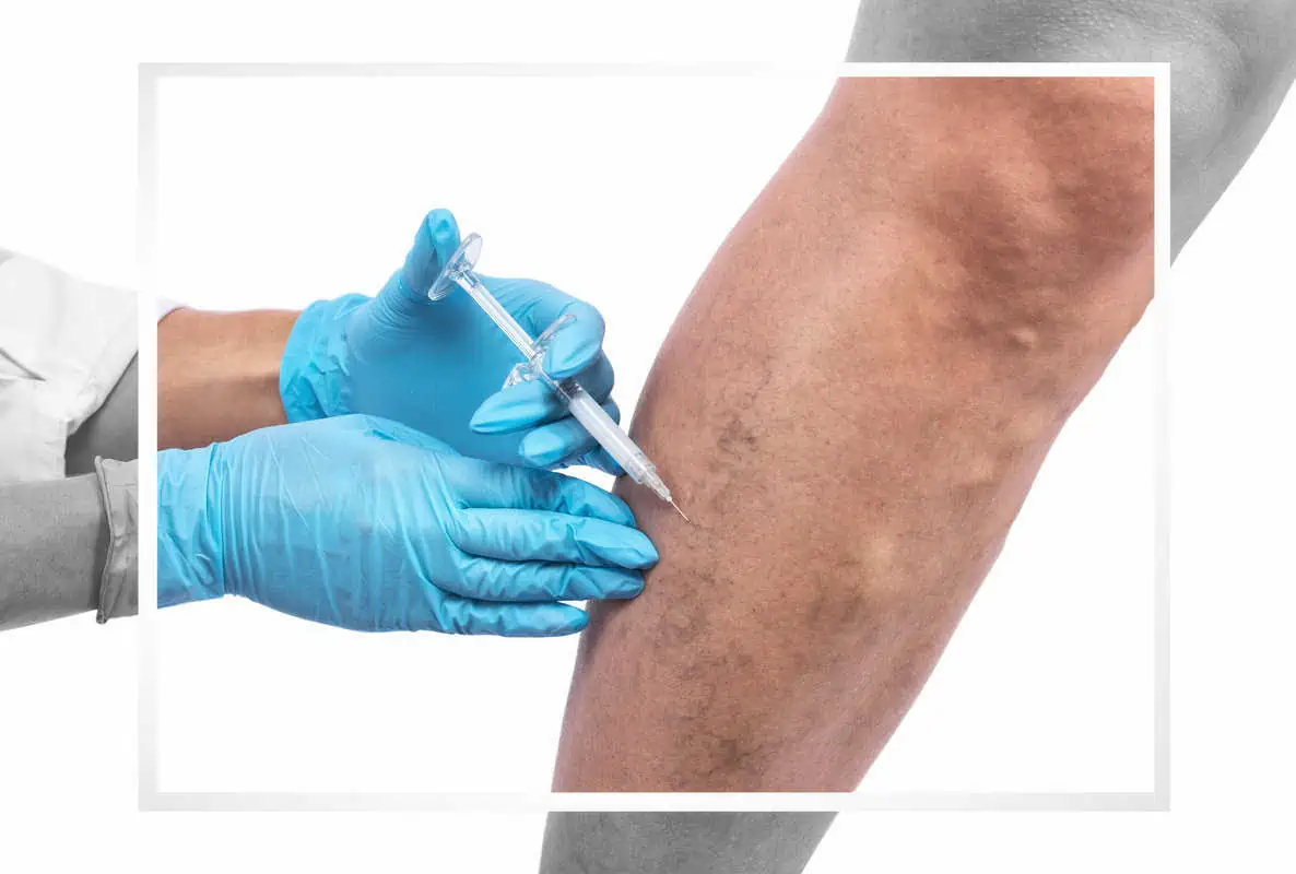 Therma Vein Work | Gladiators Health MD