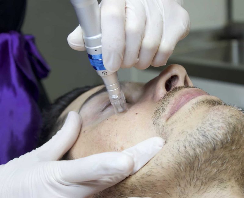 Microneedling in Riverdale, UT | Gladiator Health MD Riverdale UT