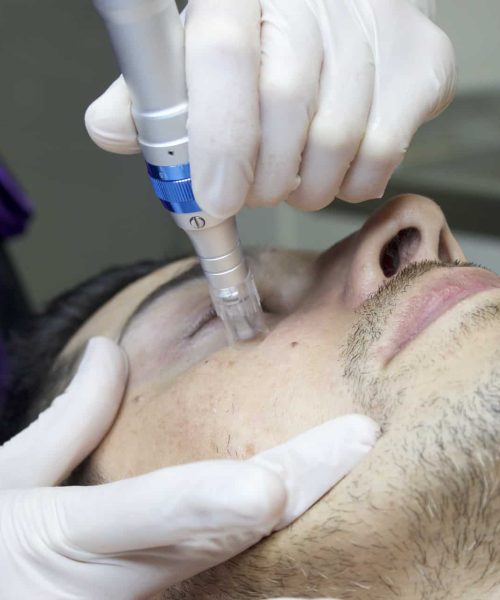 Microneedling in Riverdale, UT | Gladiator Health MD Riverdale UT